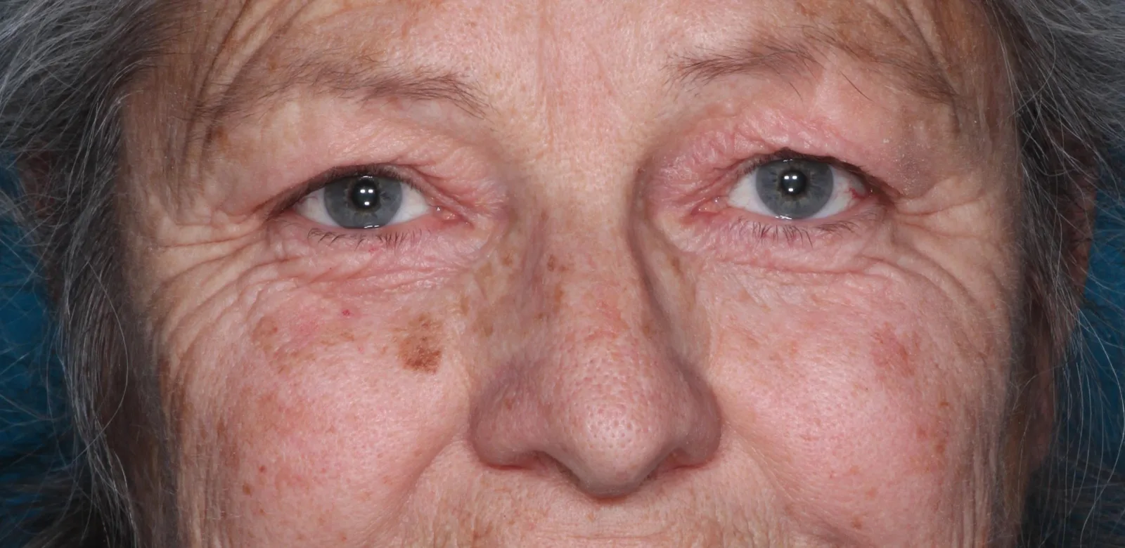 Before functional upper lid blepharoplasty case 9 at Skin Secrets